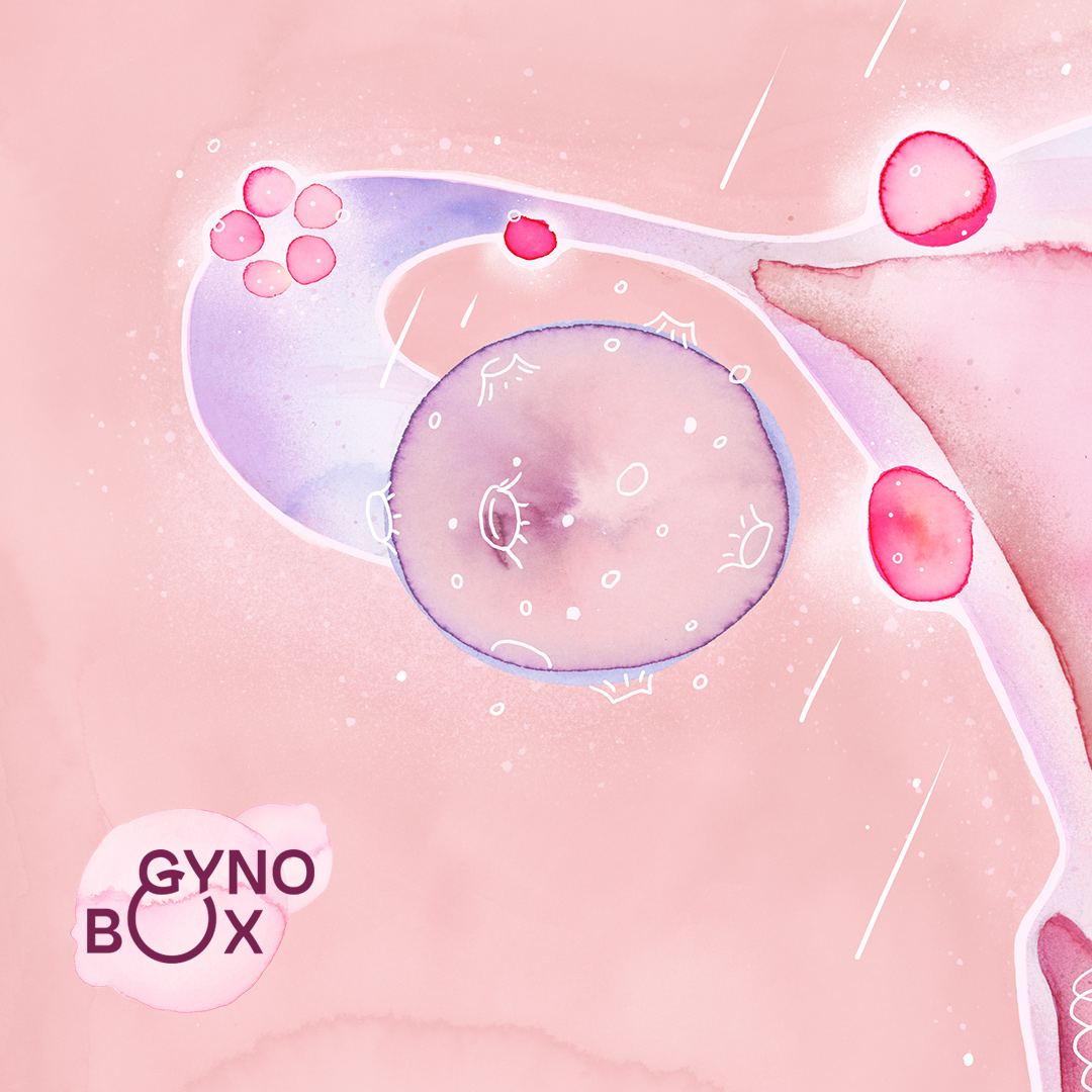 gynobox endometrioza